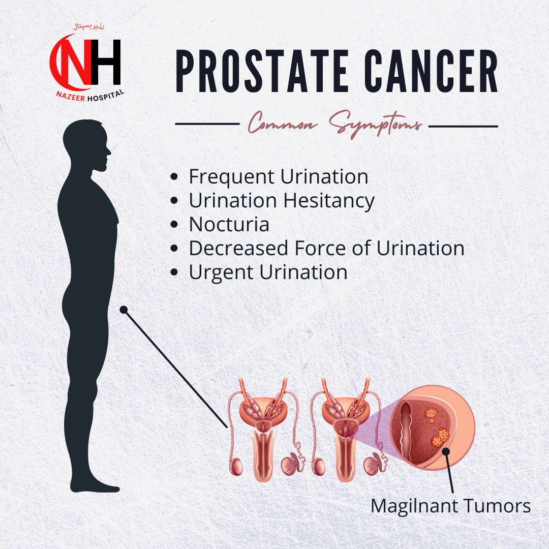 Prostate Cancer - Nazeer Hospital