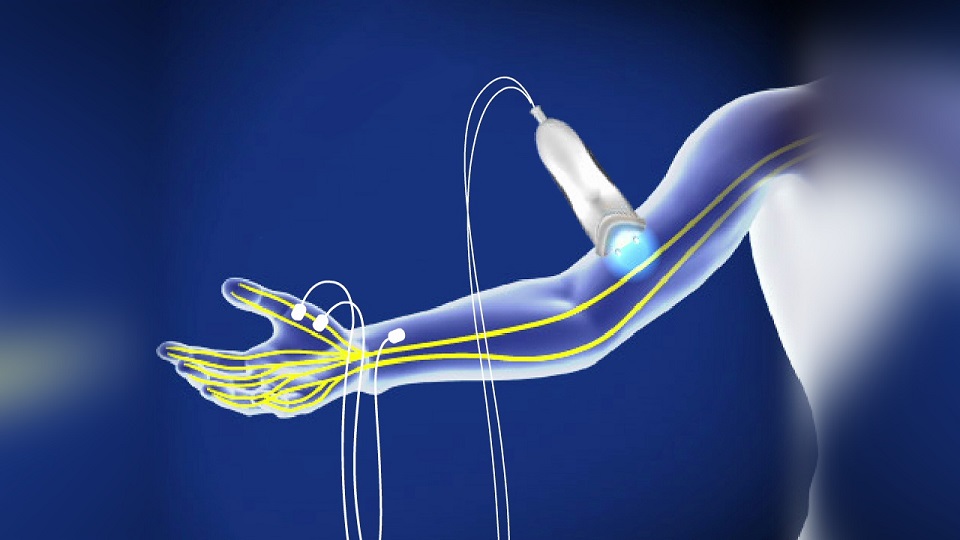 Nerve Conduction Studies (NCS)